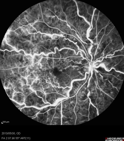 図3 網膜中心静脈閉塞症(CRVO)の蛍光眼底像