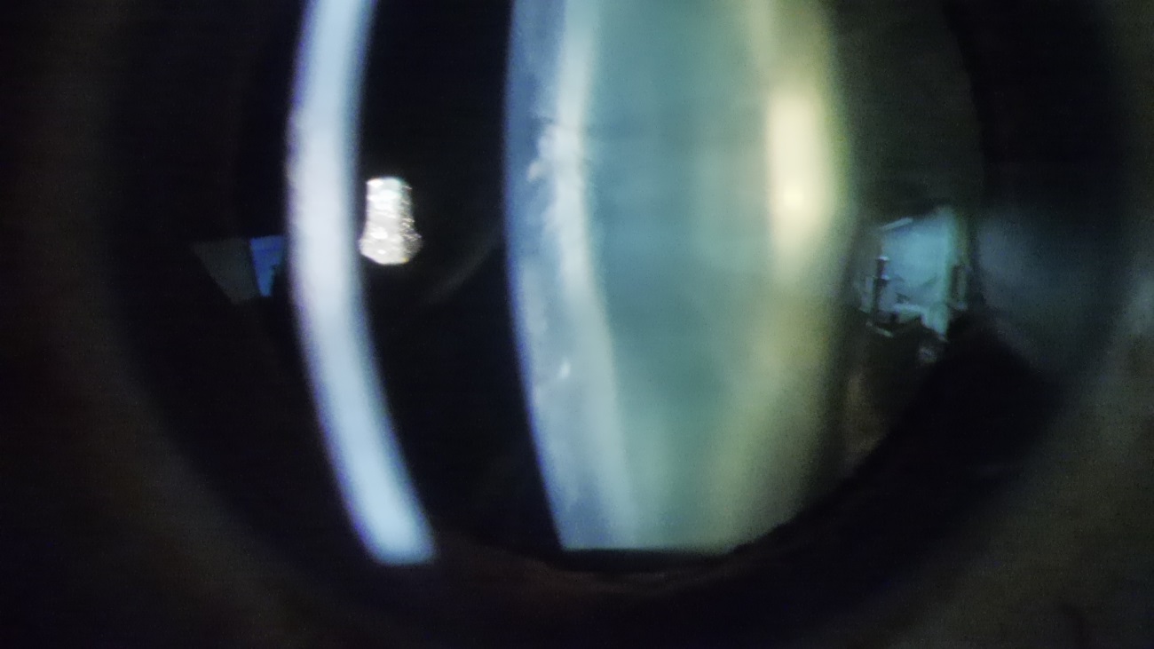 図4b細隙灯顕微鏡で拡大して観察した角膜と水晶体;