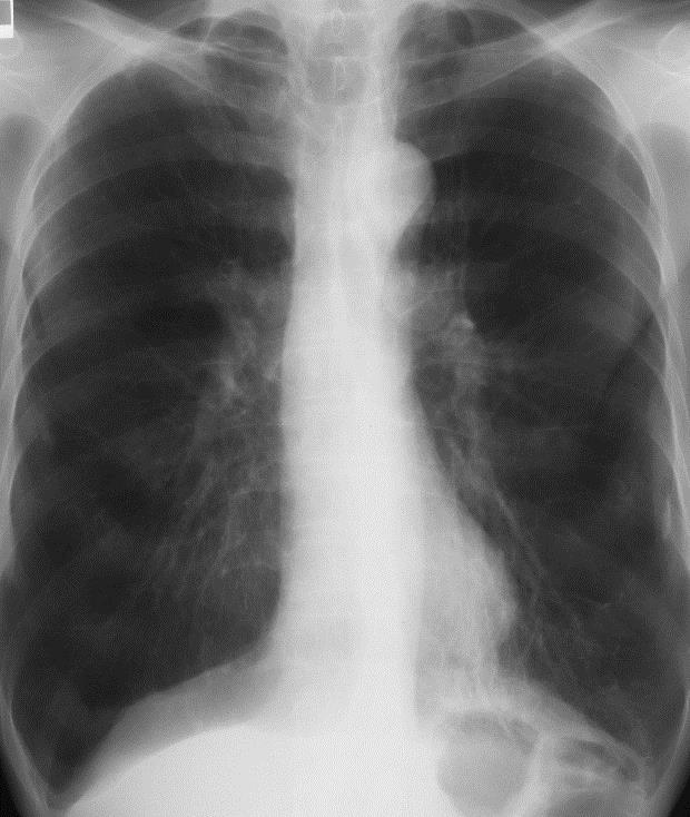 図1 肺気腫患者の胸部レントゲン