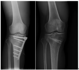 図5 右膝OWHTO術直後X線像と術後10か月抜釘術後