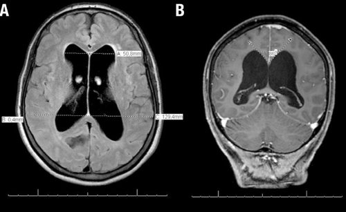 図1 特発性正常圧水頭症患者の頭部MRI画像