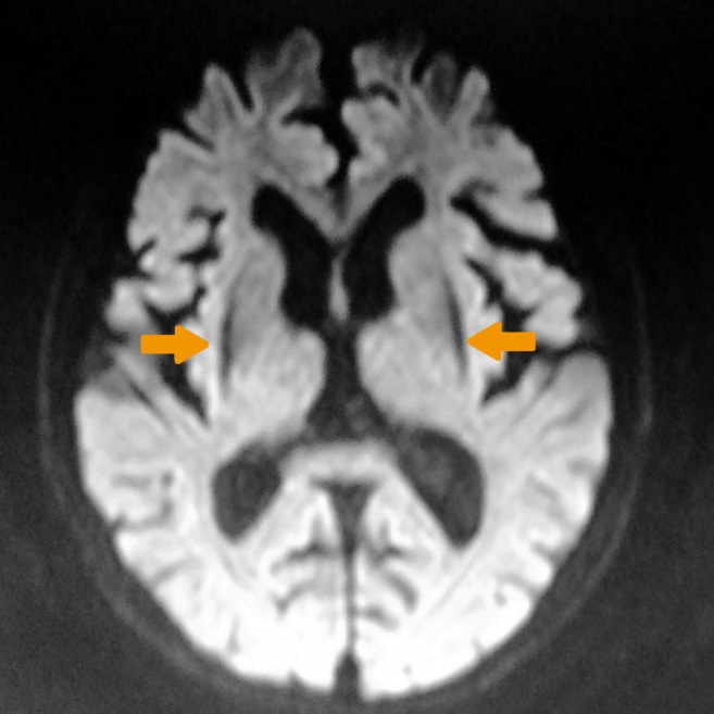 図3 大脳基底核型では大脳基底核の一つである被殻が黒っぽくみえる