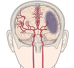 図1 脳血管のイラスト