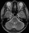 MRI(磁気共鳴画像）