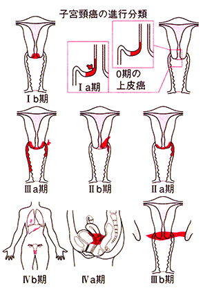 子宮がんの進行分類