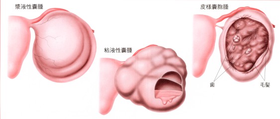 参考　代表的な卵巣嚢腫