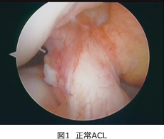 図１　正常ACL