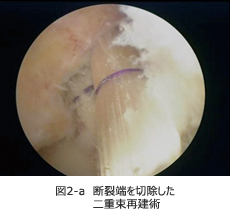 図2-a　断裂端を切除した二重束再建術