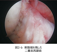 図2-b　断裂端を残した二重束再建術