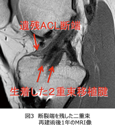 図3　断裂端を残した二重束再建術後1年のMRI像