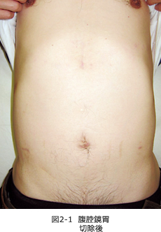 図2-1　腹腔鏡胃切除後
