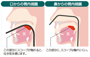口からの胃内視鏡・鼻からの胃内視鏡
