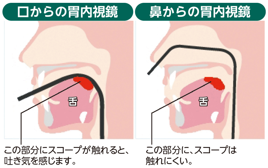 口からの内視鏡検査よりも苦しくありません