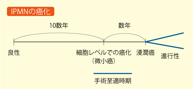 IPMNの癌化