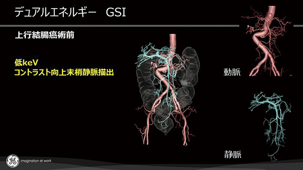 図２ 造影剤を静脈注射しながら一度の撮影で動脈と静脈とを分けた立体像を作ることができ、患者さんの負担を少なくしつつ手術前の情報がより詳しく得られます。（画像はGEヘルスケア社提供）