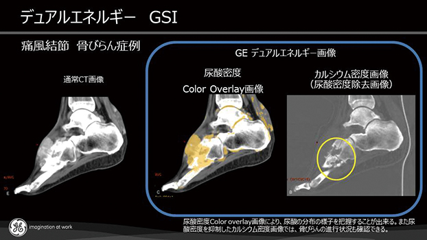 図３ 痛風結節のなかの尿酸の成分を直接画像にして、通常の検査では分からないその正確な場所を突き止めることができます。（画像はGEヘルスケア社提供）