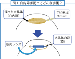 白内障手術ってどんな手術？