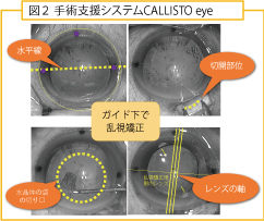 手術支援システムCALLISTO eye