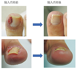 陥入爪術前・術後