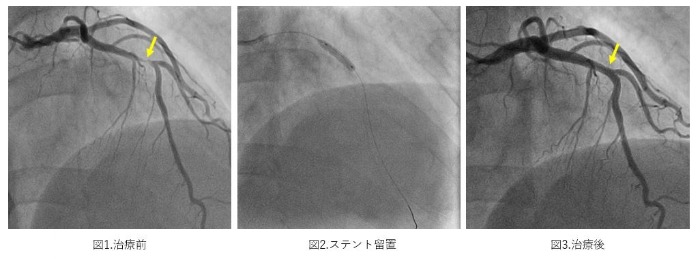 ステント留置治療前後