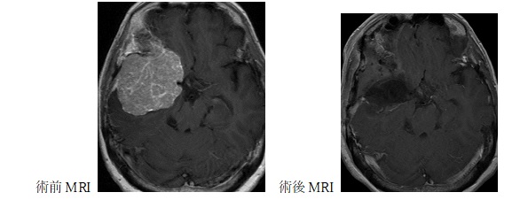 代表症例2のMRI画像