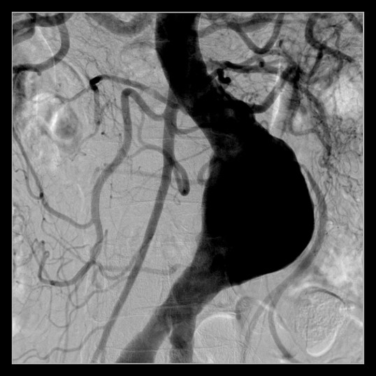 腹部大動脈瘤