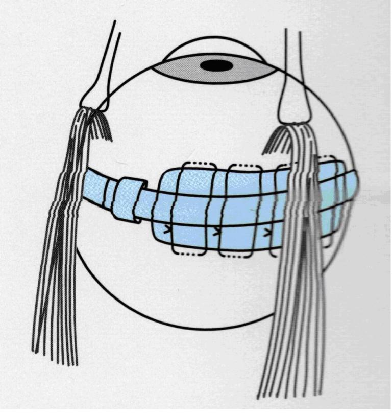 図1 強膜バックリング手術の外観