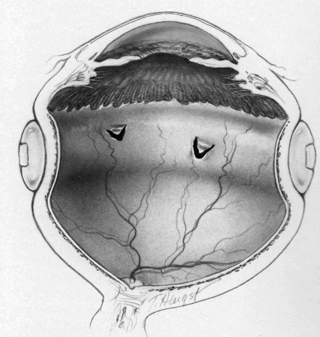 図2 強膜バックリング手術の眼球断面