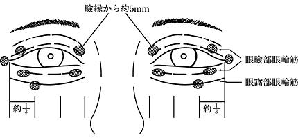 図2.眼瞼けいれんでボトックスを注射する場所