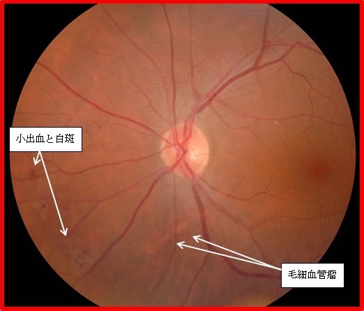 図5 単純網膜症