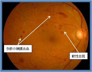 図6 増殖前網膜症