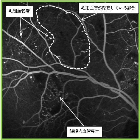 図7 増殖前網膜症のフルオレセイン蛍光眼底撮影像