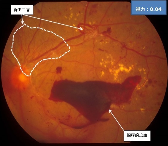 図8 重症増殖網膜症