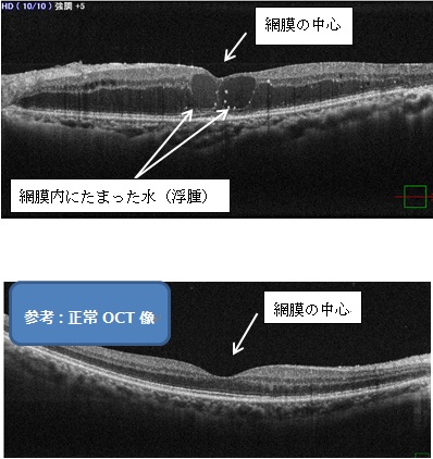 図10 図9の黄斑部のOCT断面像