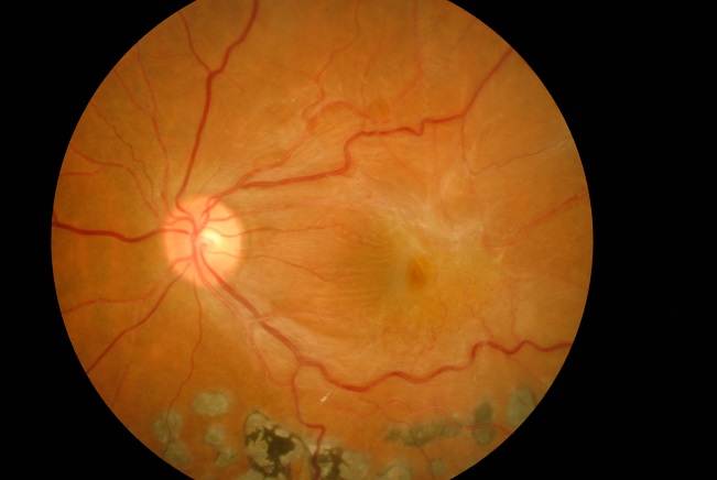 図2 黄斑前膜の眼底写真