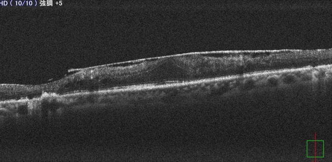 図4 黄斑前膜のOCT画像 