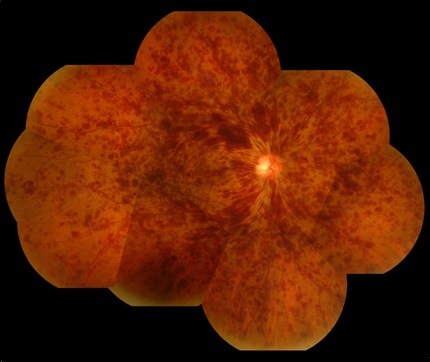図1 網膜中心静脈閉塞症の眼底写真