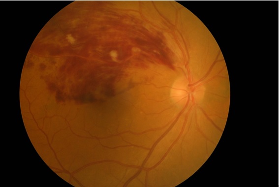 図2 網膜静脈分枝閉塞症の眼底写真