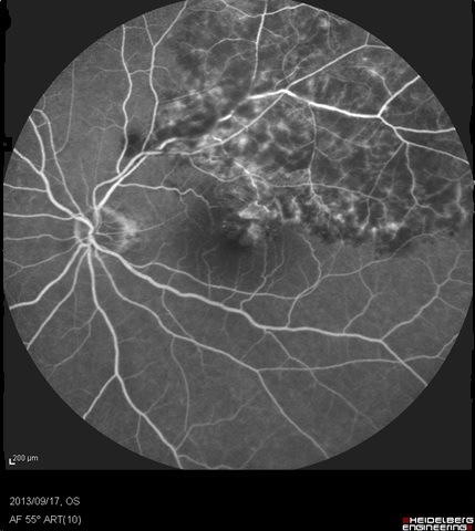 図4 網膜静脈分枝閉塞症(BRVO)の蛍光眼底像