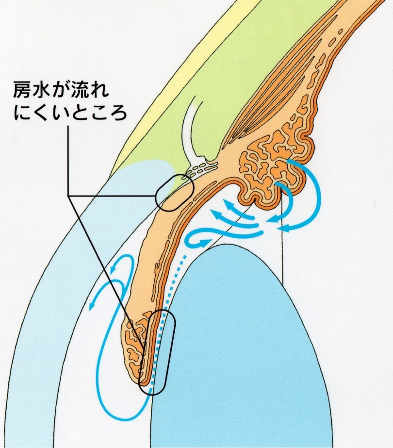 図3b 閉塞隅角