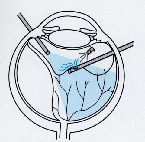 図2 硝子体手術の図