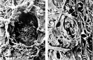 図3 レーザー治療後の繊維柱帯の電子顕微鏡写真 