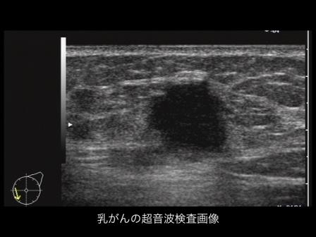 乳がんの超音波検査画像