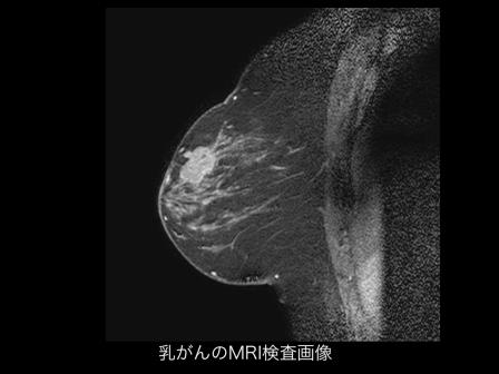 乳がんのMRI検査画像