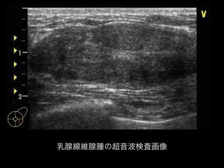 乳腺線維腺腫の超音波画像