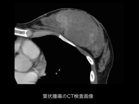 葉状腫瘍のCT検査画像