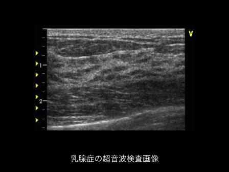 乳腺症の超音波検査画像