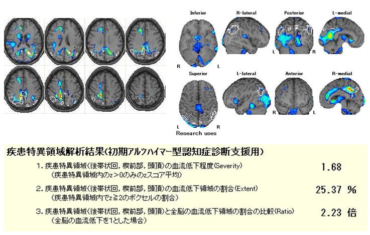 脳血流シンチの解析結果例