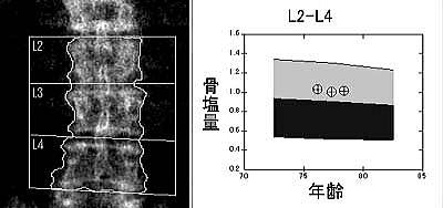 骨塩定量検査結果のグラフ