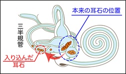 良性発作性頭位めまい症の耳石の位置